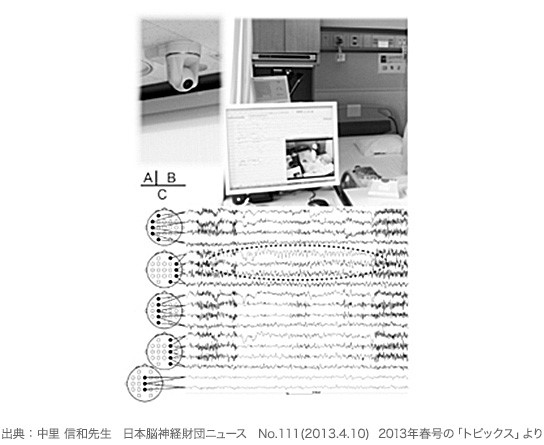 診断 診断と治療 てんかんinfo