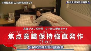 意識があり短時間、右下肢の硬直を示す　焦点意識保持強直発作（その１）