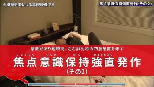 意識があり短時間、左右非対称の四肢硬直を示す　焦点意識保持強直発作（その２）